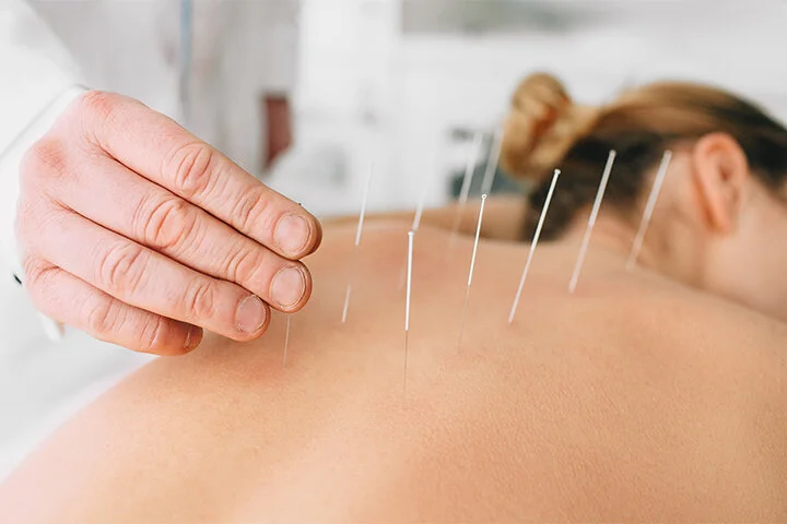 Acupuncture