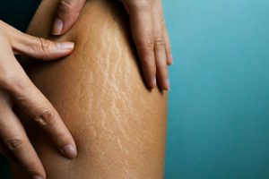 Cellulite