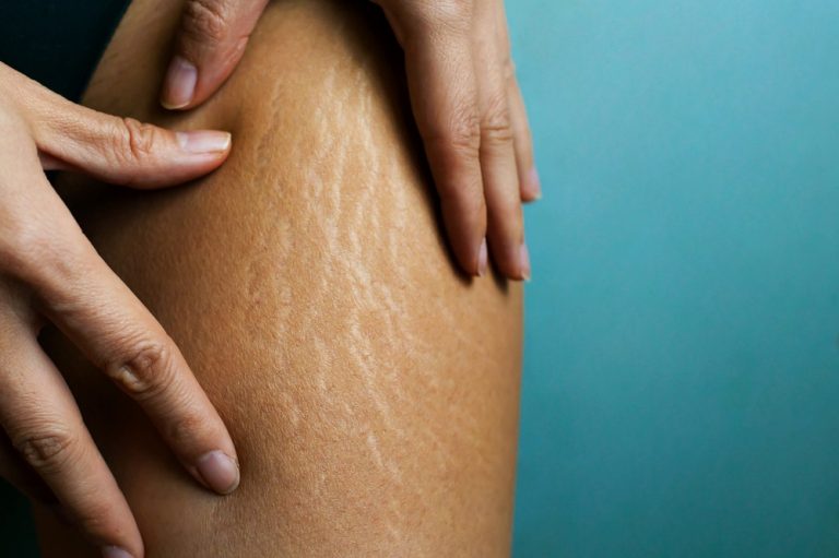 Cellulite