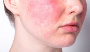 Rosacea